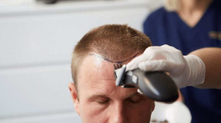 hair transplant
